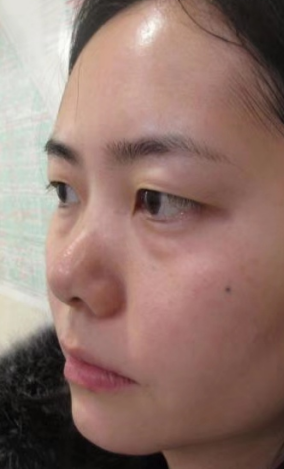 去眼袋手术