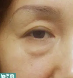 眼袋