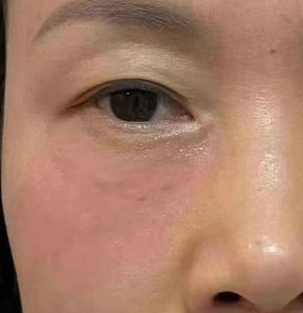 眼袋