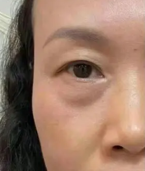 眼袋