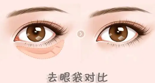 去眼袋手术