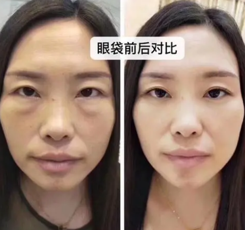 去眼袋手术
