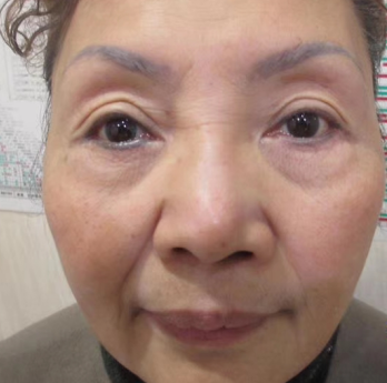 去眼袋手术