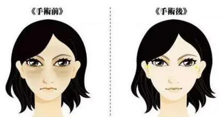 去眼袋手术