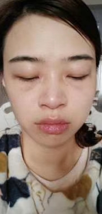 去眼袋手术