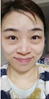 去眼袋手术