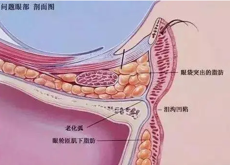 去眼袋手术