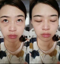 去眼袋手术