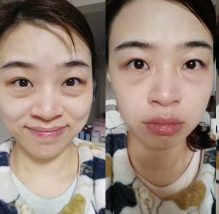 去眼袋手术