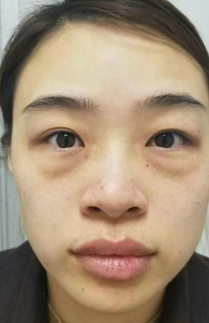 去眼袋手术