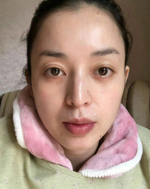 去眼袋手术