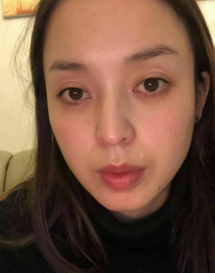 去眼袋手术