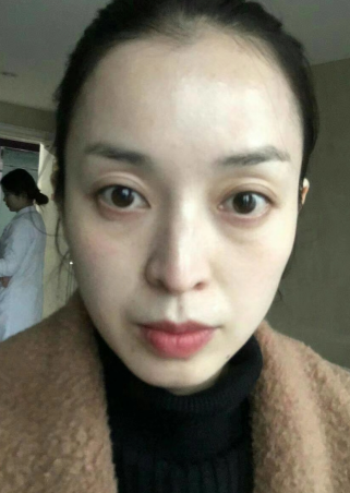 去眼袋手术