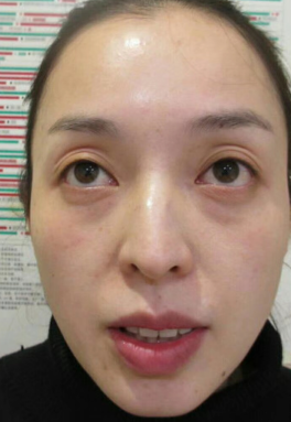 去眼袋手术
