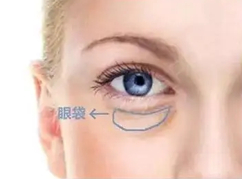 眼袋