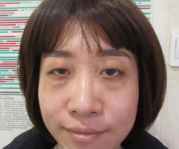 去眼袋手术