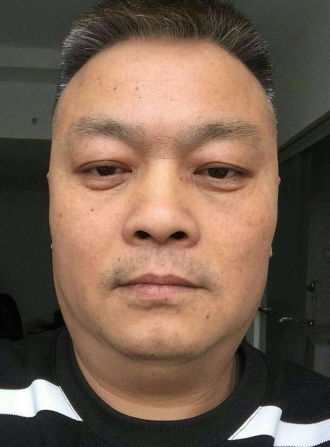 去眼袋手术