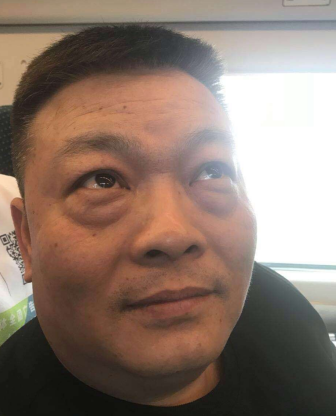 去眼袋手术
