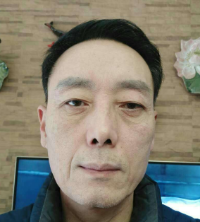 去眼袋手术