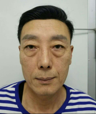 去眼袋手术