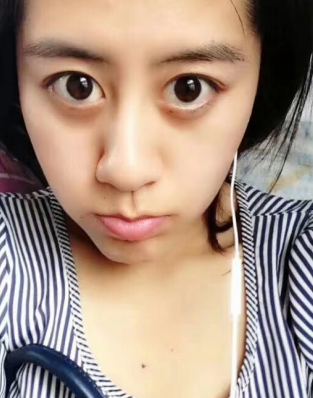 去眼袋手术