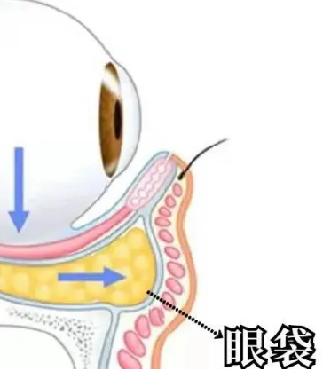 去眼袋手术