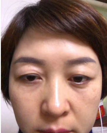 去眼袋手术