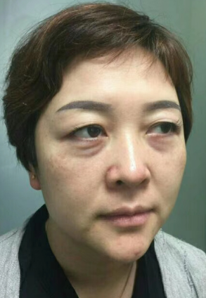 去眼袋手术