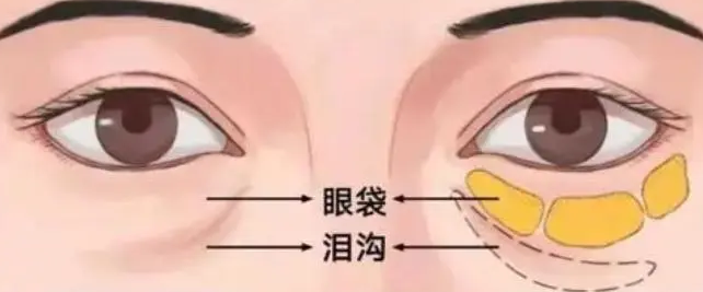 眼袋