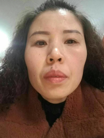 去眼袋手术