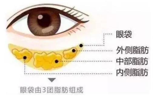 去眼袋手术