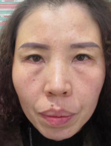 去眼袋手术