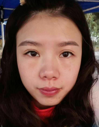 去眼袋手术