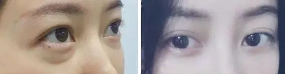 眼袋