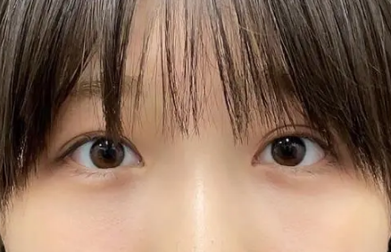 眼袋