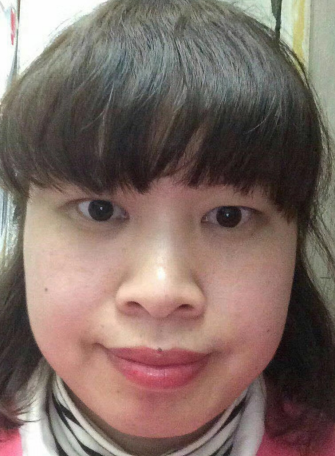 去眼袋手术