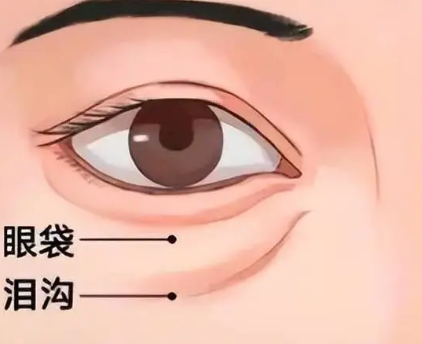 去眼袋手术