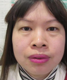 去眼袋手术