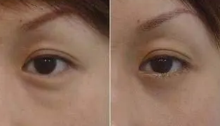 眼袋