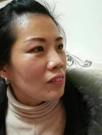 去眼袋手术