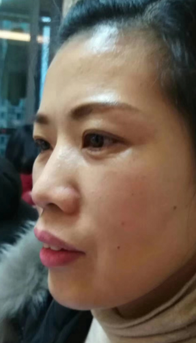 去眼袋手术