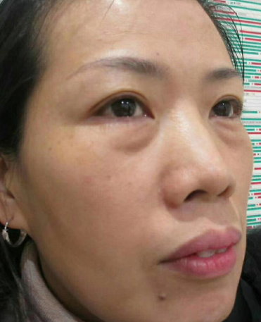 去眼袋手术