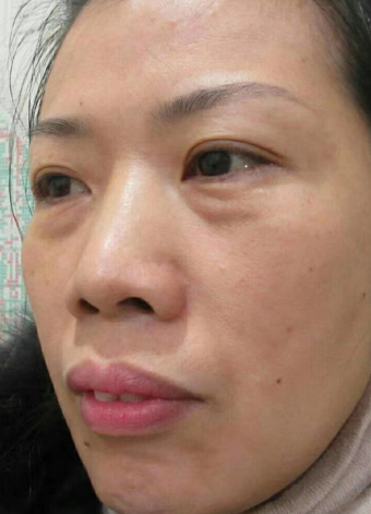 去眼袋手术