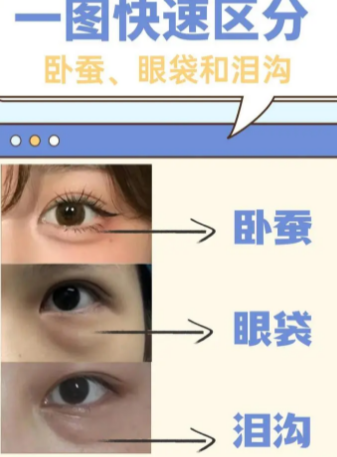 眼袋