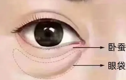 眼袋