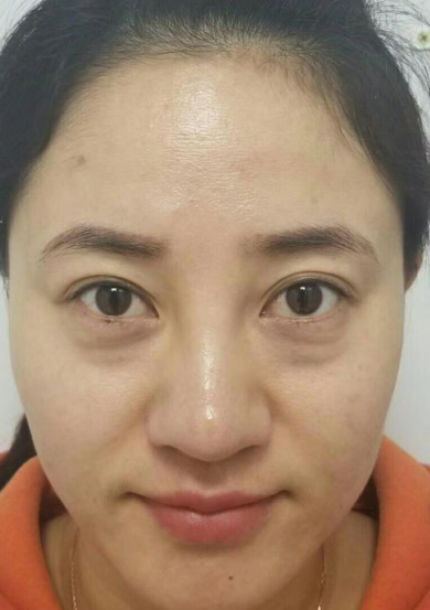 去眼袋手术