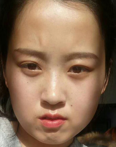 去眼袋手术