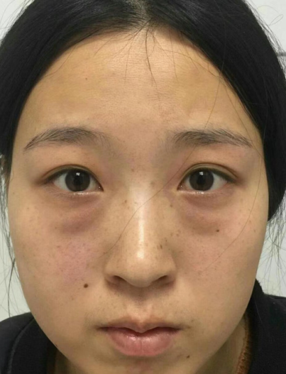 去眼袋手术