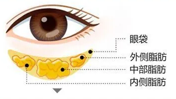 去眼袋手术