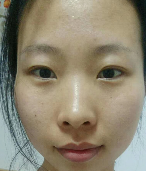 去眼袋手术